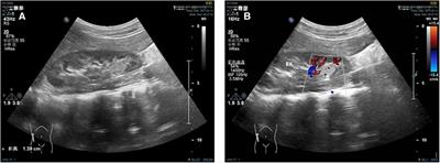 MiT family translocation renal cell carcinoma with retroperitoneal metastasis in childhood: a case report